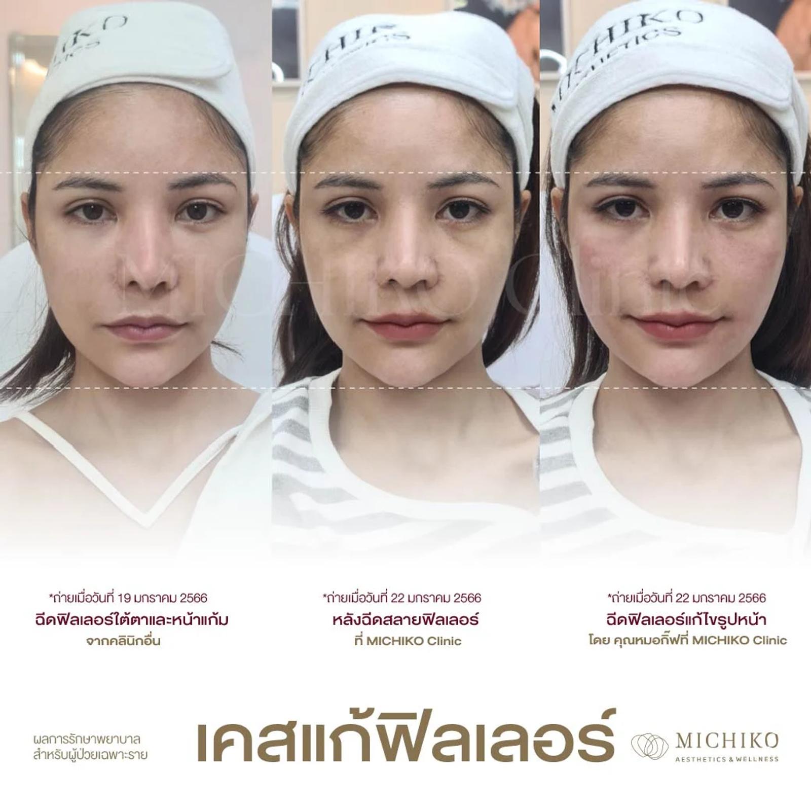 MICHIKO filler correction case. Individual results vary.