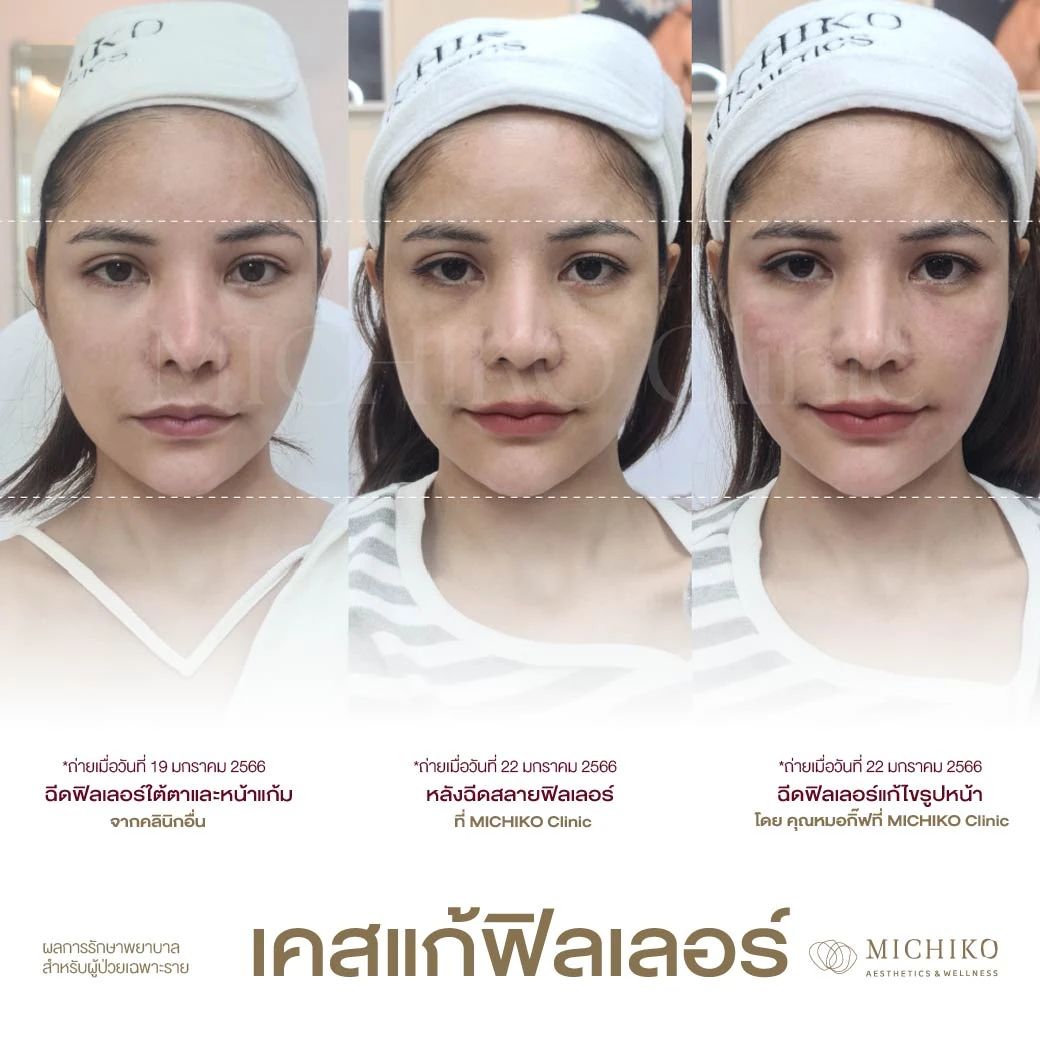 ลำดับการแก้ไขฟิลเลอร์ที่ MICHIKO เคส 08