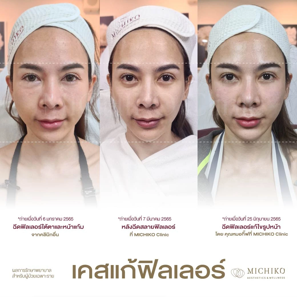 ลำดับการแก้ไขฟิลเลอร์ที่ MICHIKO เคส 09