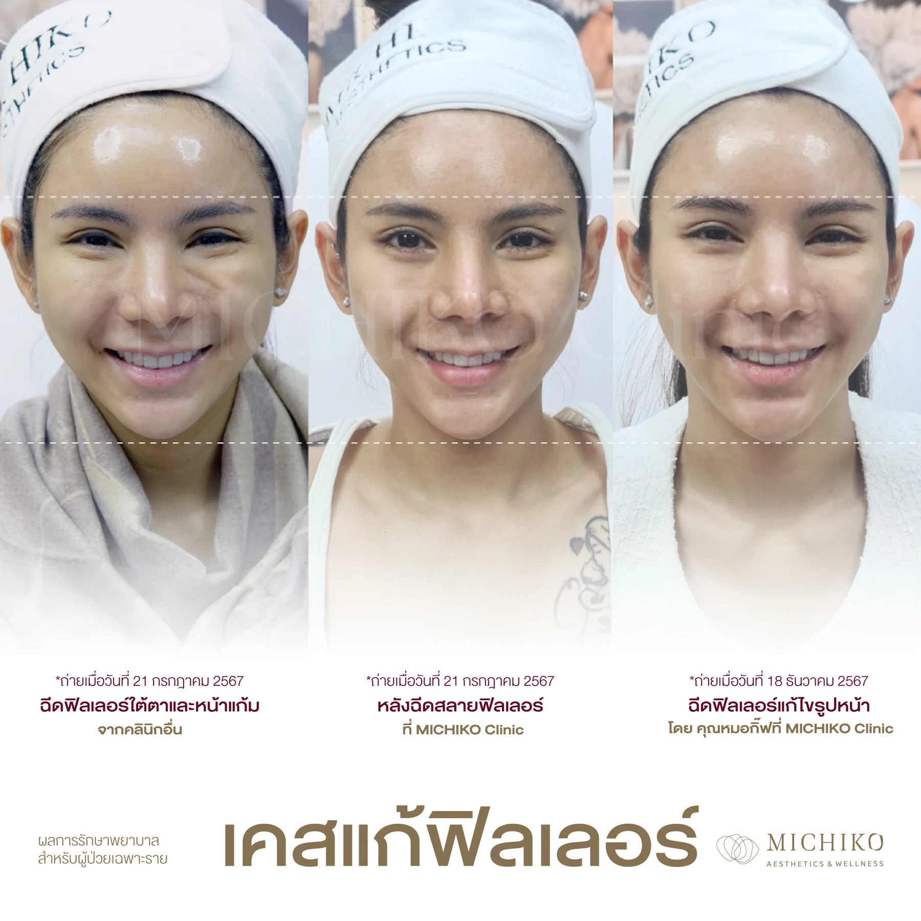 ค่อย ๆ ปรับความเต็ม ให้รอยยิ้มดูเป็นธรรมชาติขึ้น