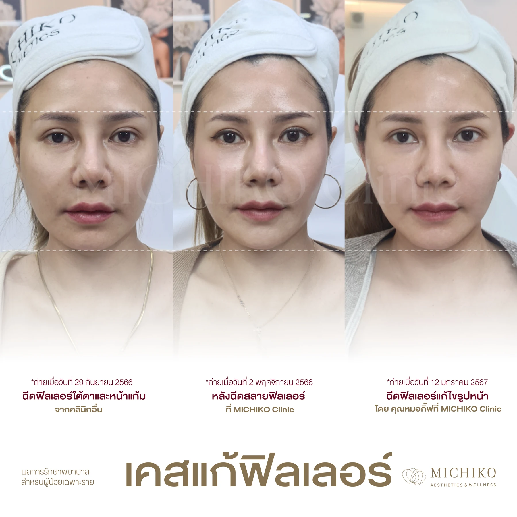 ลำดับการแก้ไขฟิลเลอร์ที่ MICHIKO เคส 14