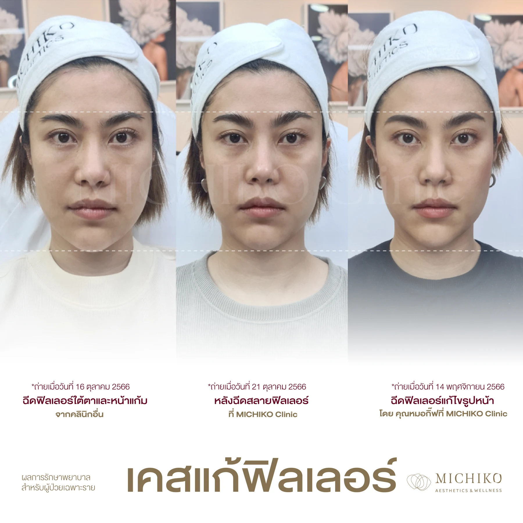 ลำดับการแก้ไขฟิลเลอร์ที่ MICHIKO เคส 15