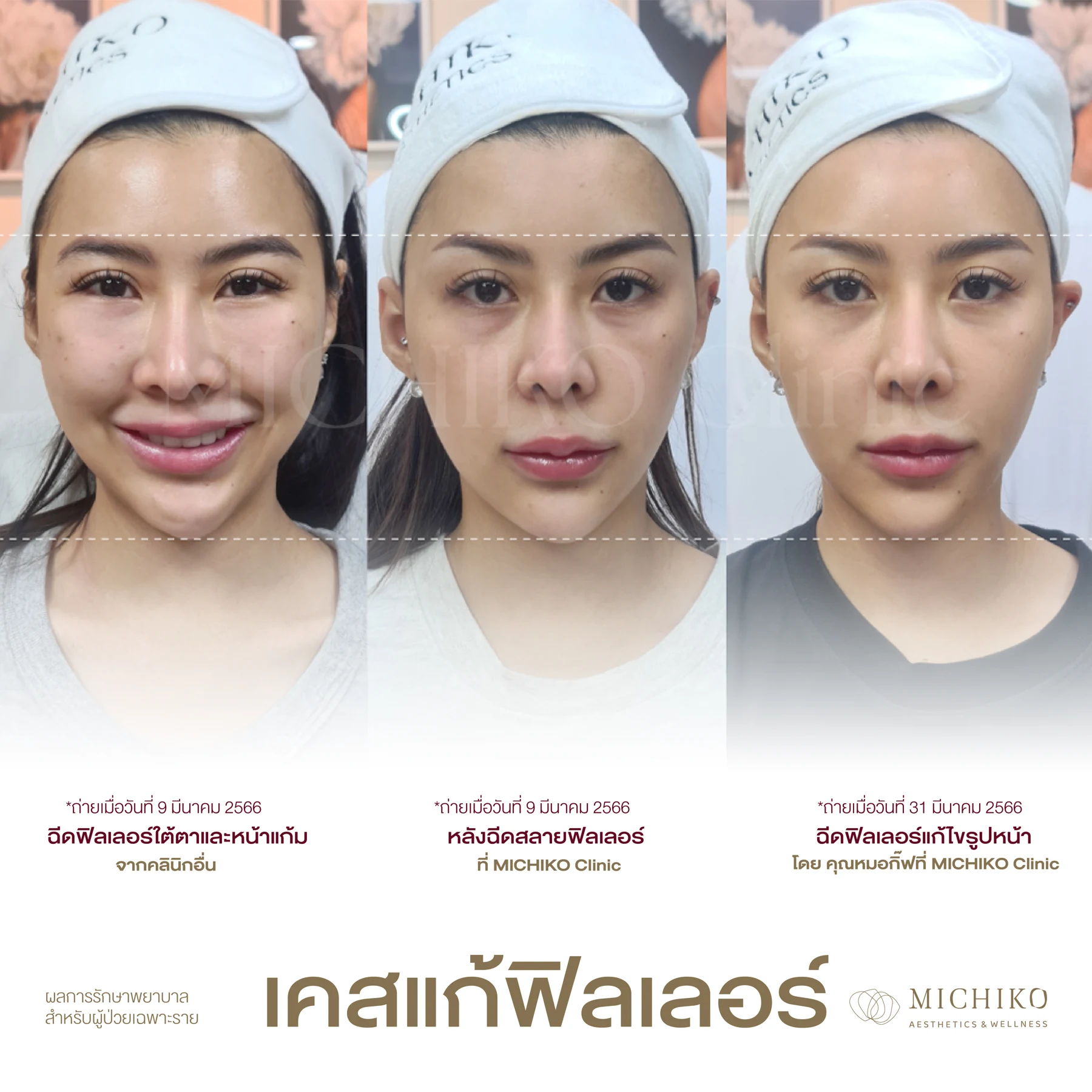 ภาวะฟิลเลอร์เกิน