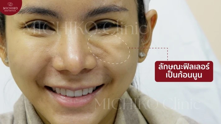 ตัวอย่างลักษณะฟิลเลอร์เป็นก้อนจากเว็บไซต์ MICHIKO