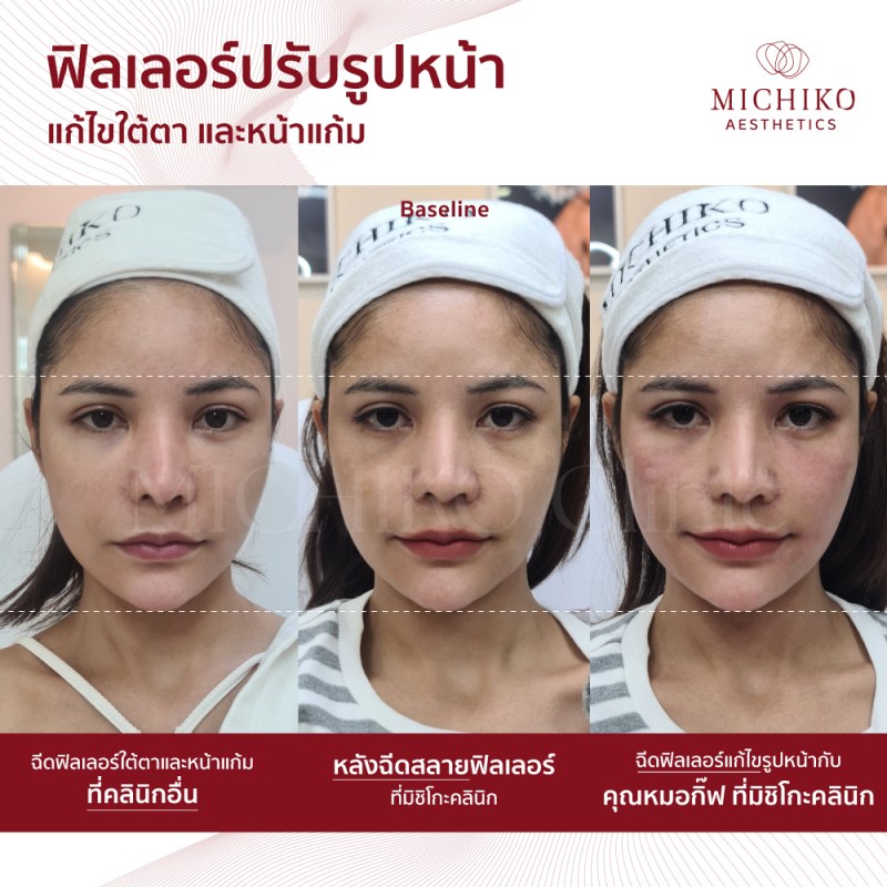 ภาพก่อนและหลังเคสสลายฟิลเลอร์ (Dissolving Filler)ที่ MICHIKO