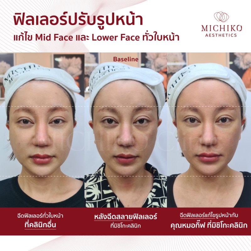ภาพก่อนและหลังเคสสลายฟิลเลอร์ (Dissolving Filler)ที่ MICHIKO