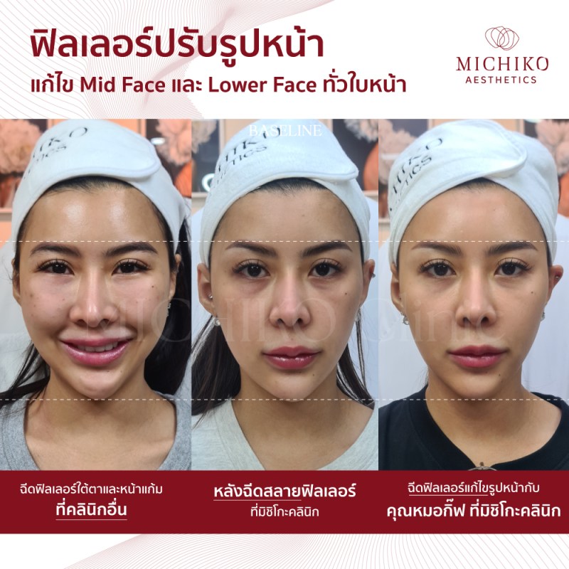 ภาพก่อนและหลังเคสสลายฟิลเลอร์ (Dissolving Filler)ที่ MICHIKO