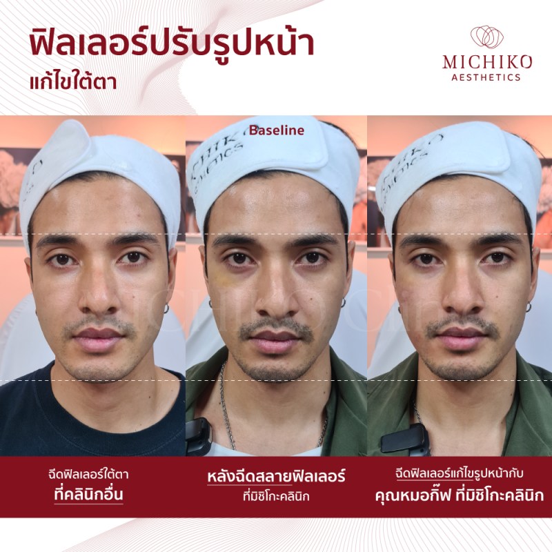 ภาพก่อนและหลังเคสสลายฟิลเลอร์ (Dissolving Filler)ที่ MICHIKO