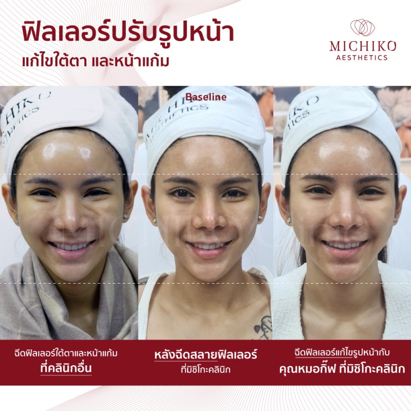 ภาพก่อนและหลังเคสสลายฟิลเลอร์ (Dissolving Filler)ที่ MICHIKO