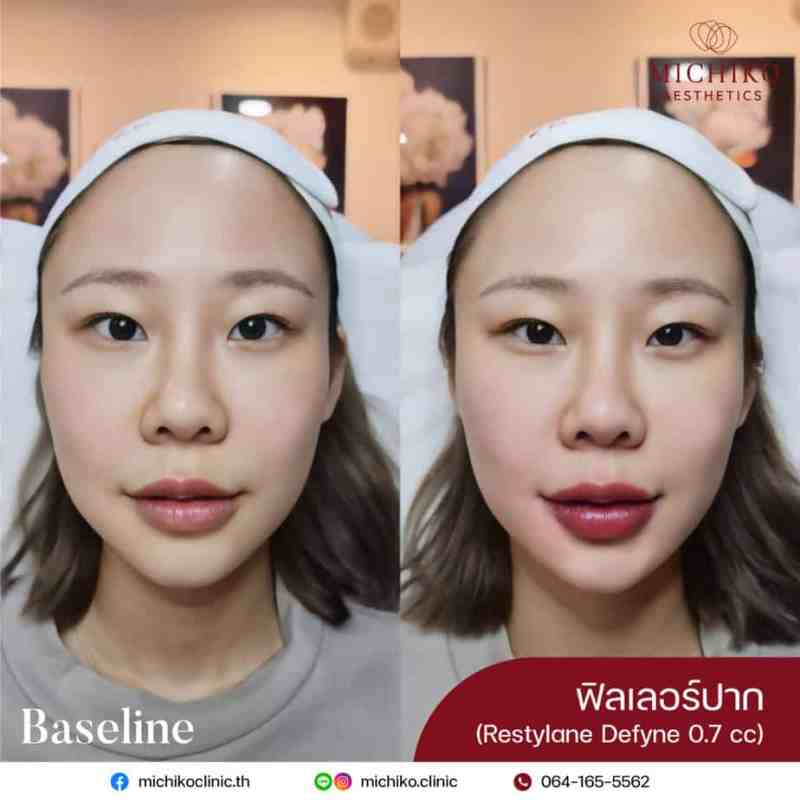 MICHIKO Lips Filler before-and-after case artwork