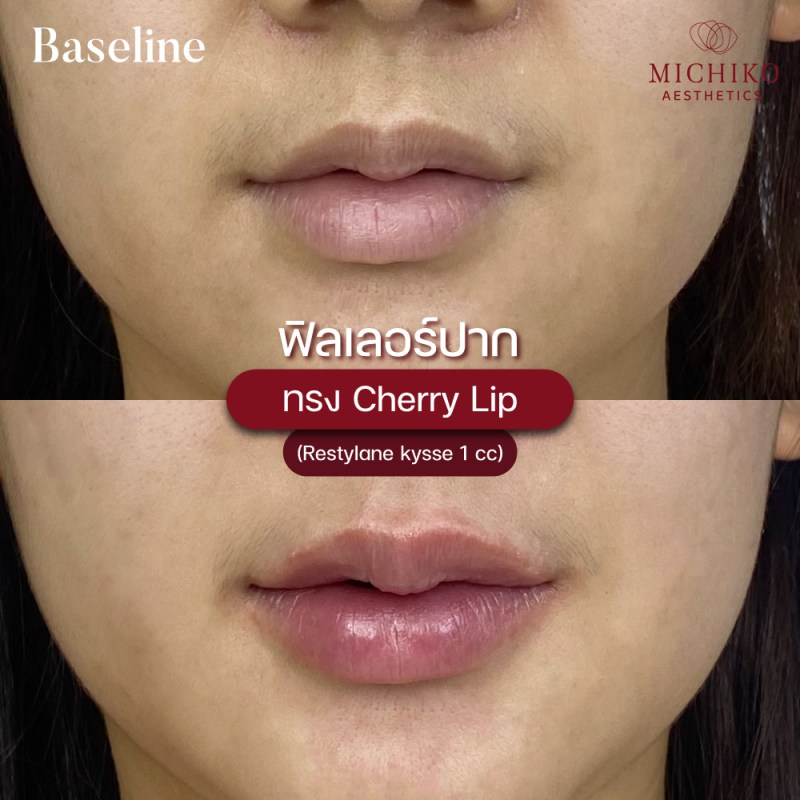 MICHIKO Lips Filler before-and-after case artwork