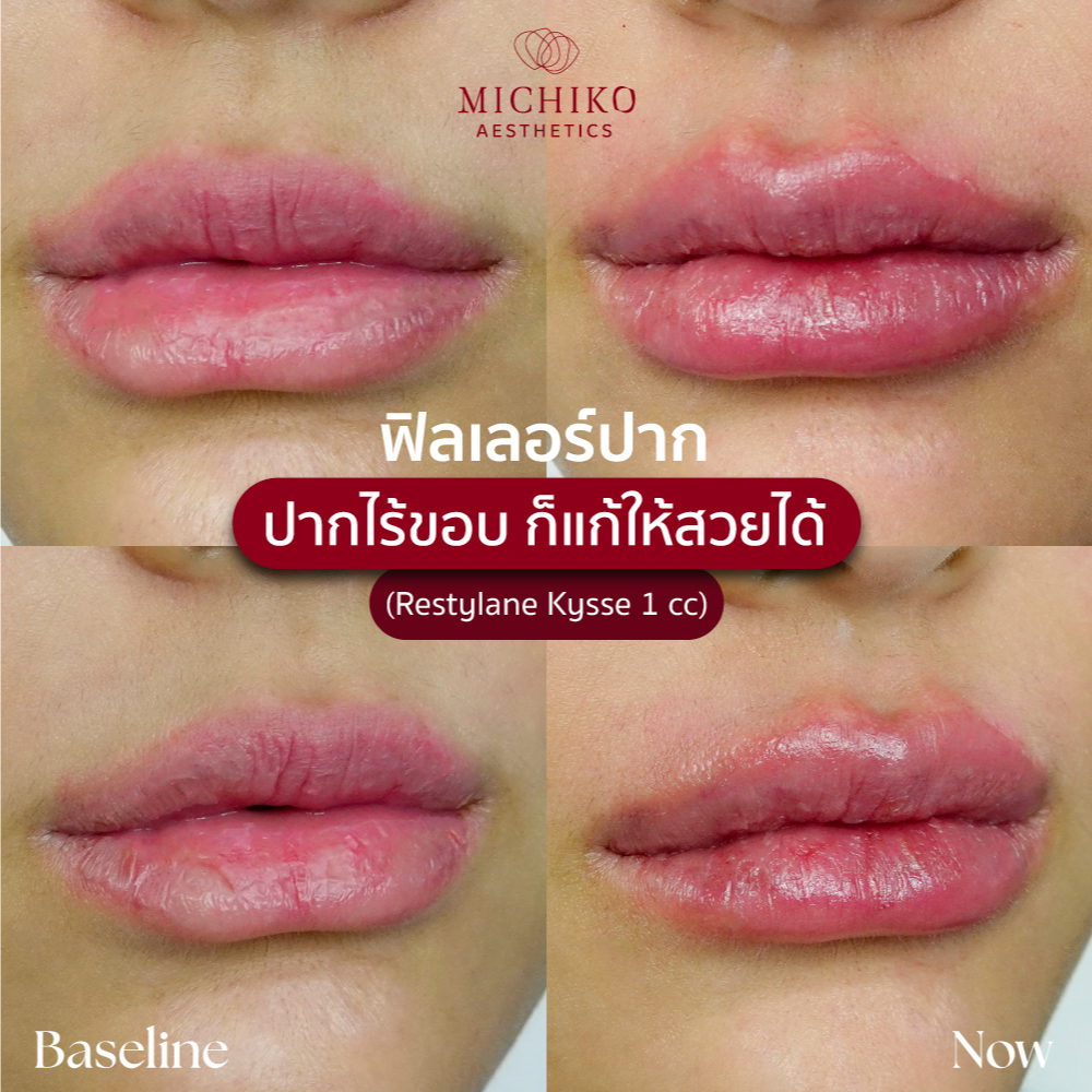 MICHIKO Lips Filler before-and-after case artwork