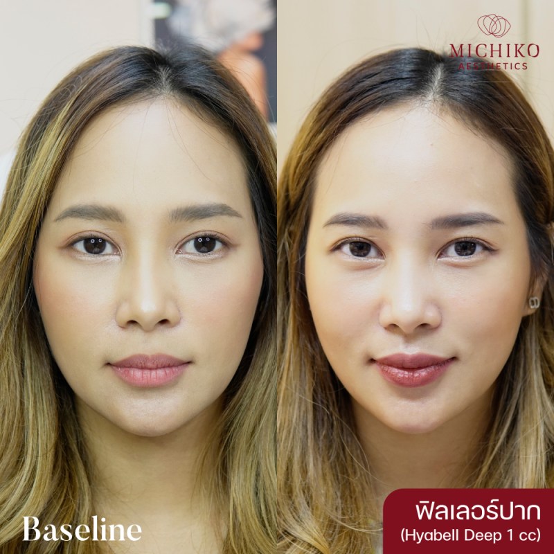 MICHIKO Lips Filler before-and-after case artwork