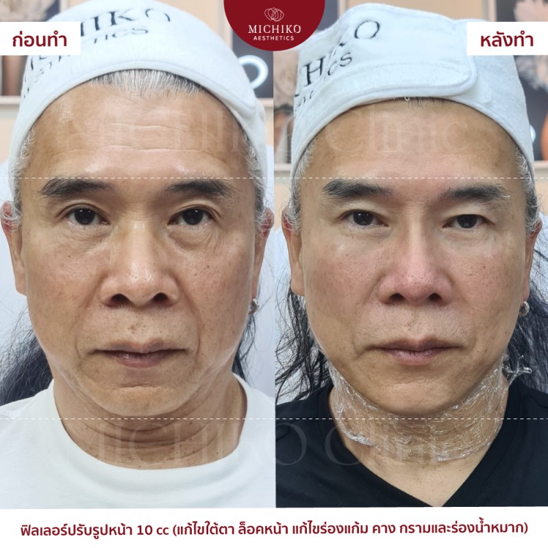 ฟิลเลอร์ปรับรูปหน้า 10 cc