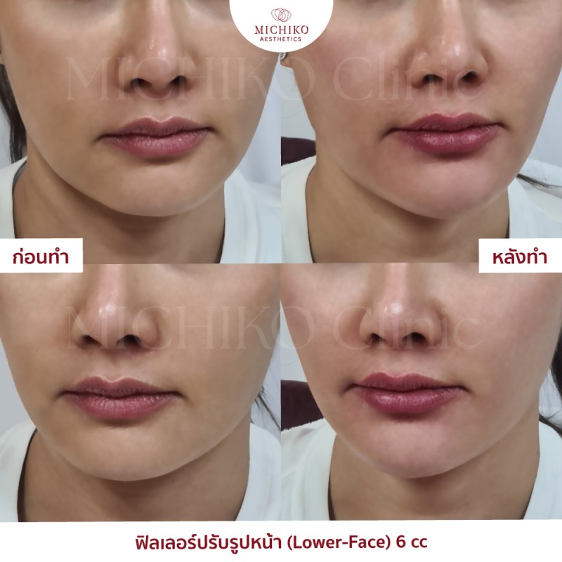 ฟิลเลอร์ปรับรูปหน้า (Lower-Face) 6 cc