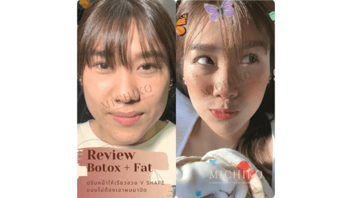 Combined Botox + Fat case
