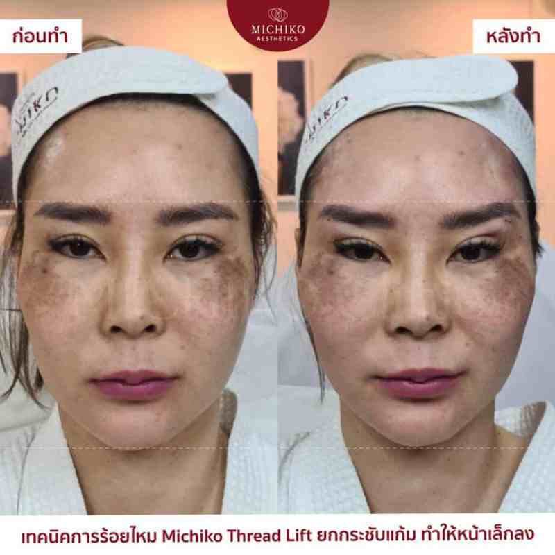 MICHIKO Thread Lift