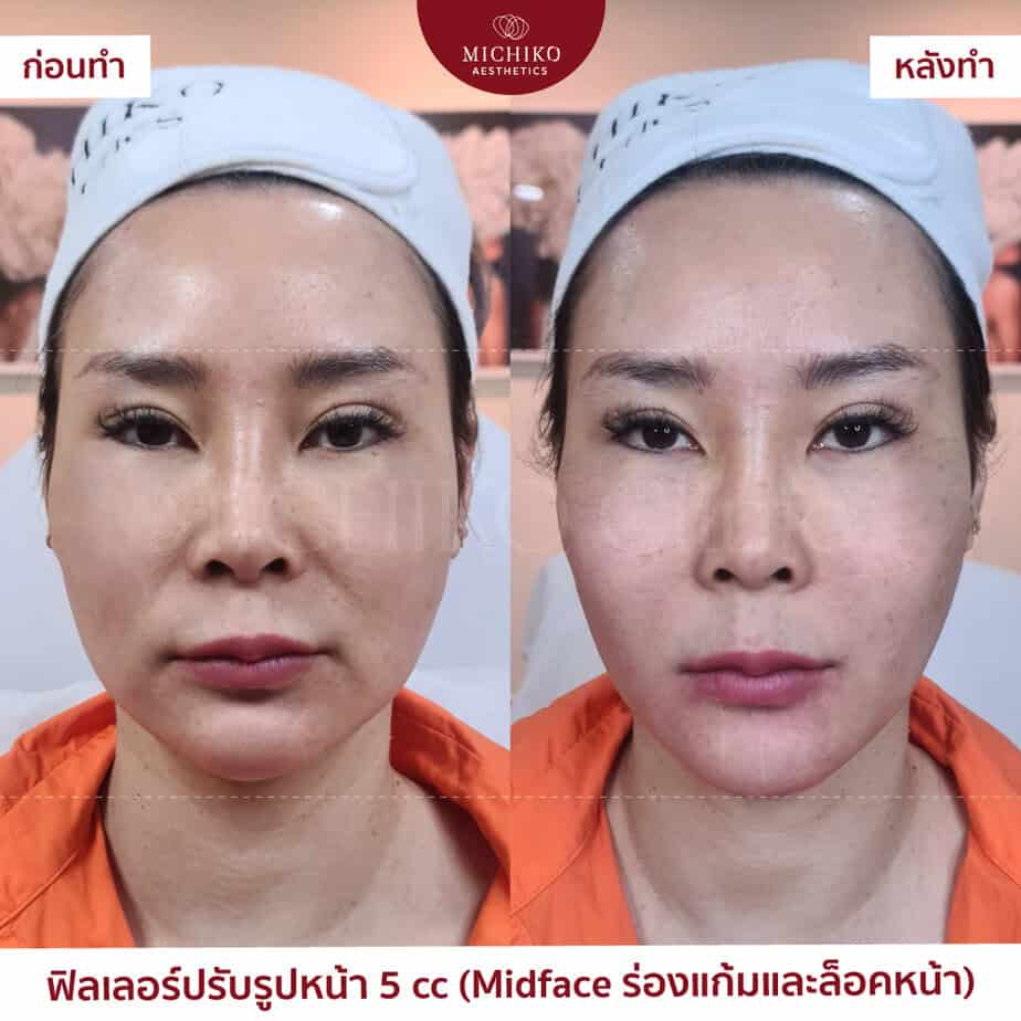 Softer folds, with the cheeks supported.