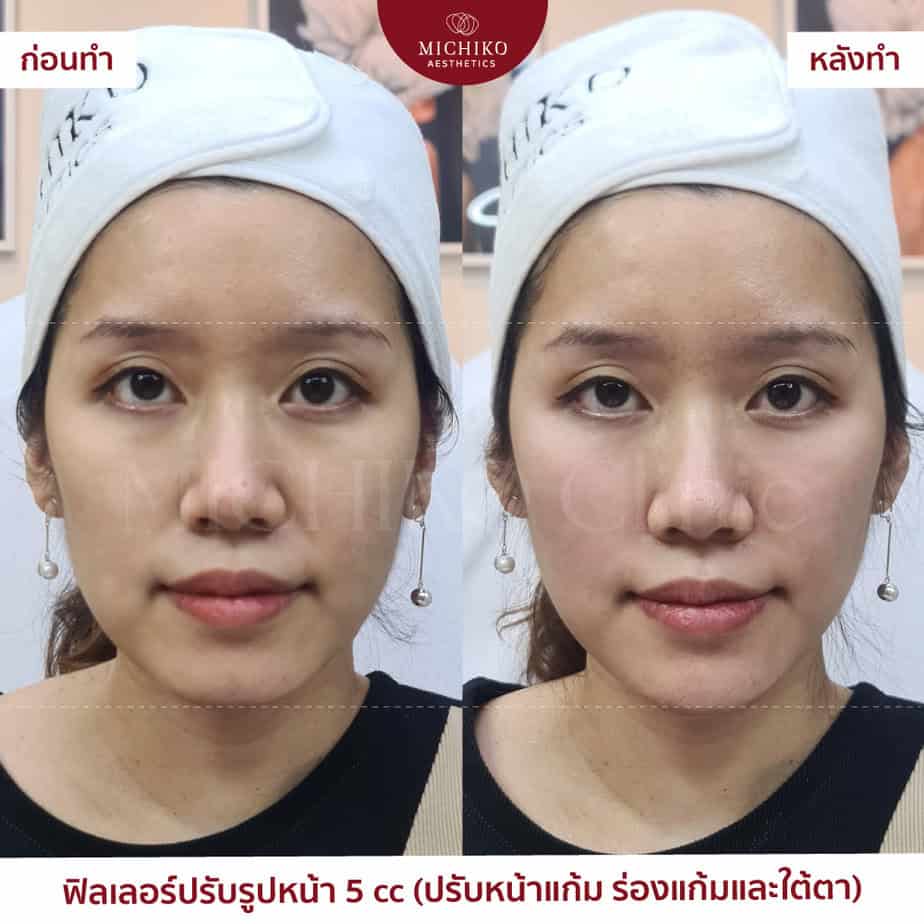 5 cc combined filler plan: cheeks, nasolabial folds and under-eyes. The original before/after labels are retained; individual results vary.
