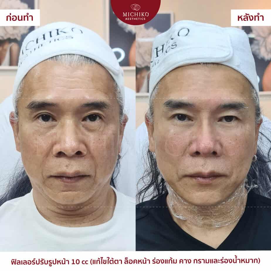 10 cc combined filler plan: under-eyes, Face-Lock, folds, chin, jaw and mouth-corner lines. The original before/after labels are retained; individual results vary.