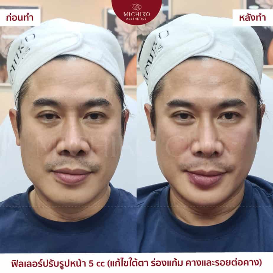 5 cc combined filler plan: under-eyes, folds, chin and the chin transition. The original before/after labels are retained; individual results vary.