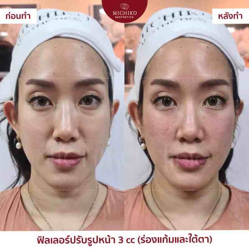 ภาพก่อนและหลังเคสฟิลเลอร์กลางหน้า (Midface)ที่ MICHIKO