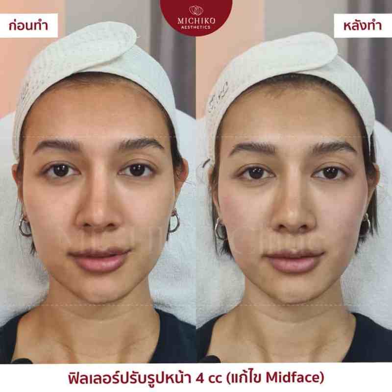 ภาพก่อนและหลังเคสฟิลเลอร์กลางหน้า (Midface)ที่ MICHIKO