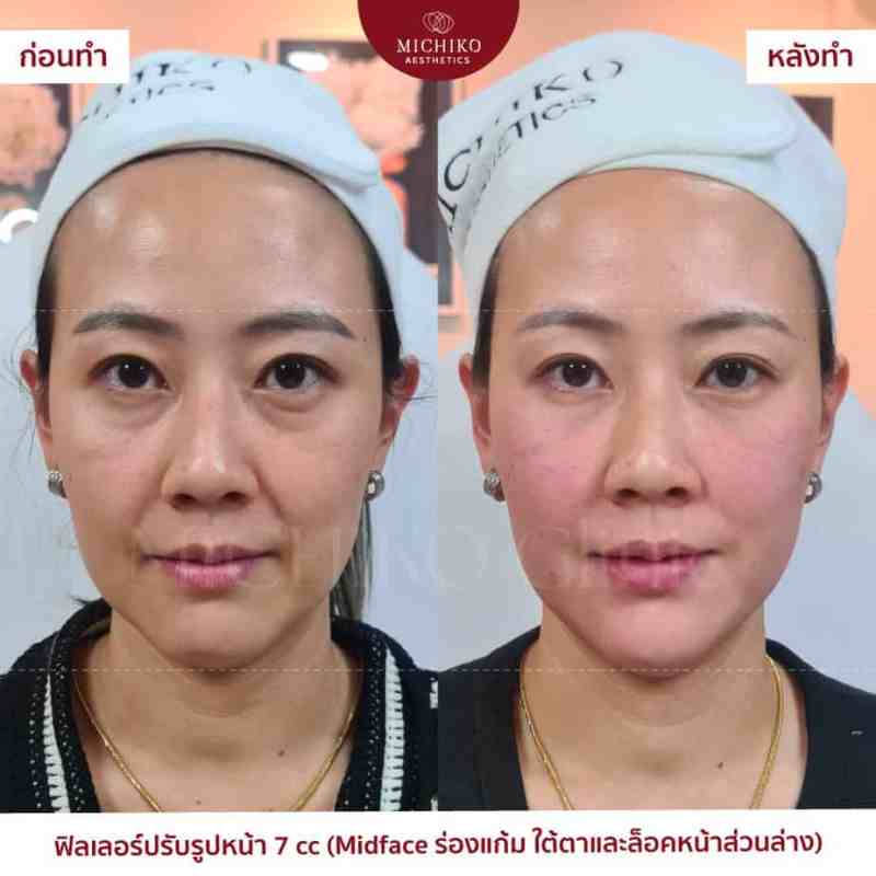 ภาพก่อนและหลังเคสฟิลเลอร์กลางหน้า (Midface)ที่ MICHIKO