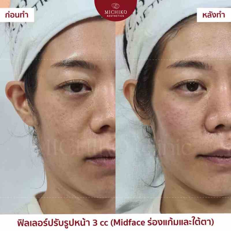 ภาพก่อนและหลังเคสฟิลเลอร์กลางหน้า (Midface)ที่ MICHIKO