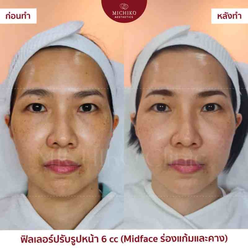 ภาพก่อนและหลังเคสฟิลเลอร์กลางหน้า (Midface)ที่ MICHIKO