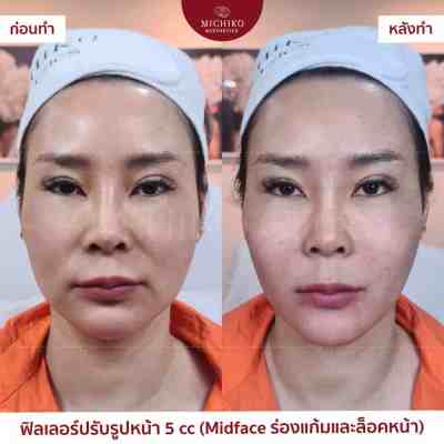 Nasolabial Folds Filler: an individual case