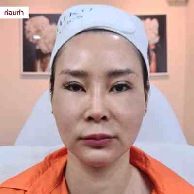 MICHIKO Nasolabial Folds Filler before-and-after case artwork