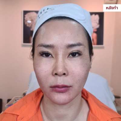 MICHIKO Nasolabial Folds Filler before-and-after case artwork