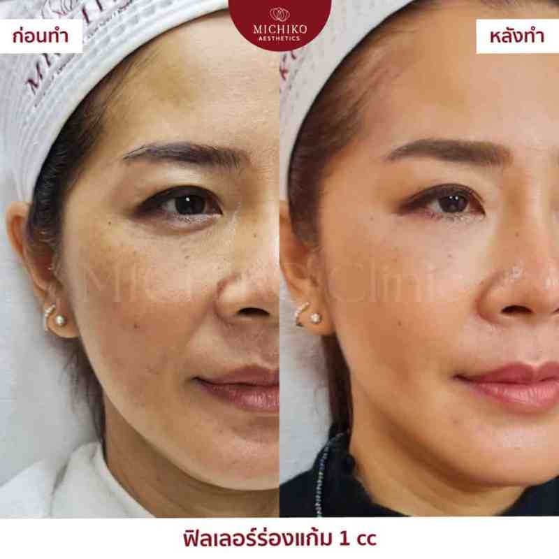 MICHIKO Nasolabial Folds Filler before-and-after case artwork