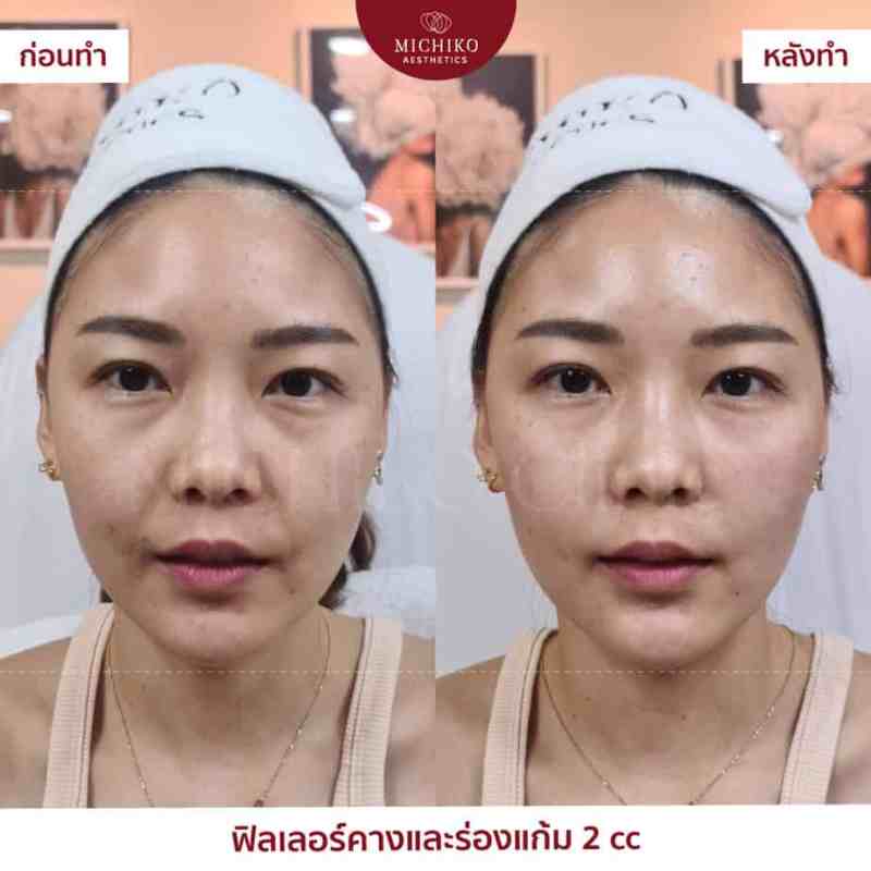 MICHIKO Nasolabial Folds Filler before-and-after case artwork