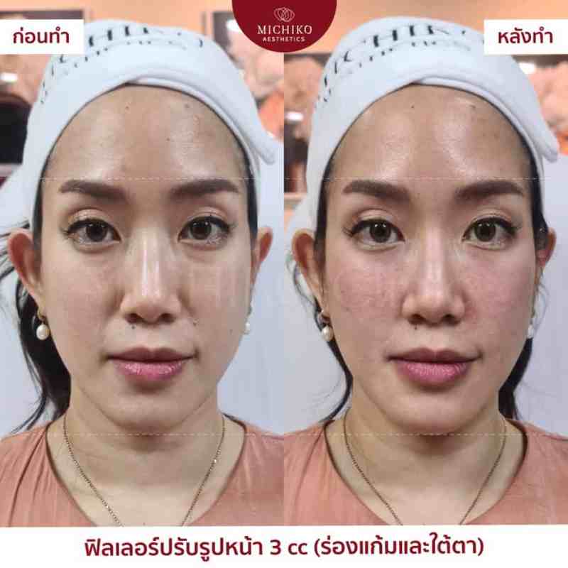 MICHIKO Nasolabial Folds Filler before-and-after case artwork