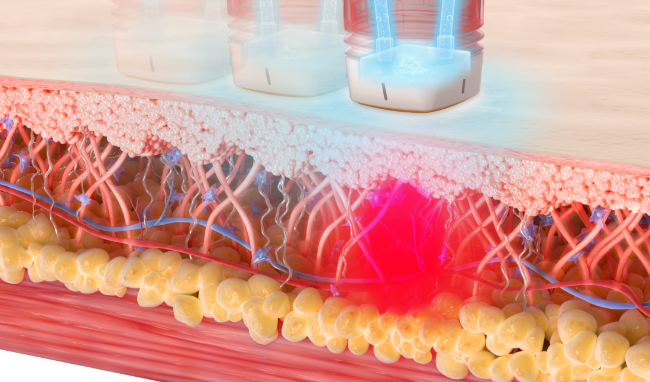 Radiofrequency energy · manufacturer’s tissue illustration