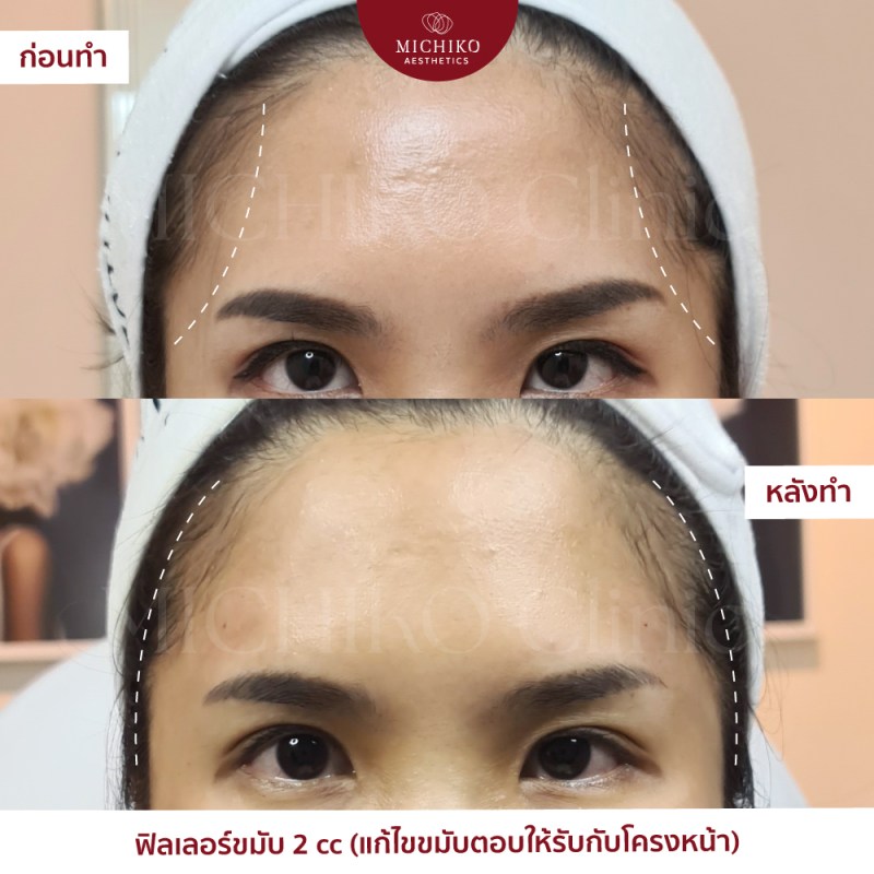 Temporal Filler: an individual case