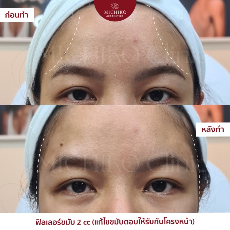 MICHIKO Temporal Filler before-and-after case artwork