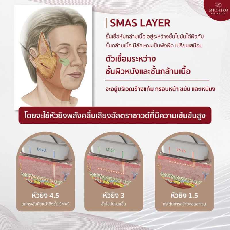 What the SMAS illustration explains