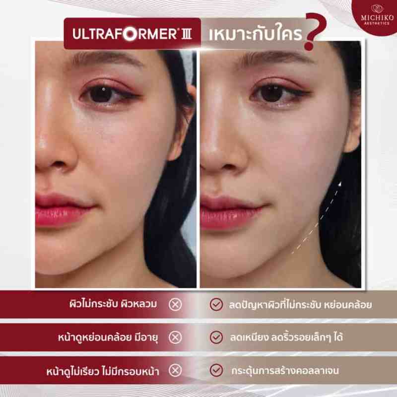 Who may discuss Ultraformer?