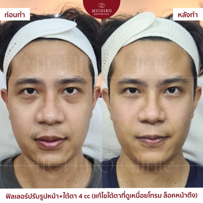 ภาพก่อนและหลังเคสฟิลเลอร์ใต้ตาที่ MICHIKO