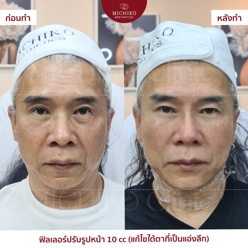 ภาพก่อนและหลังเคสฟิลเลอร์ใต้ตาที่ MICHIKO