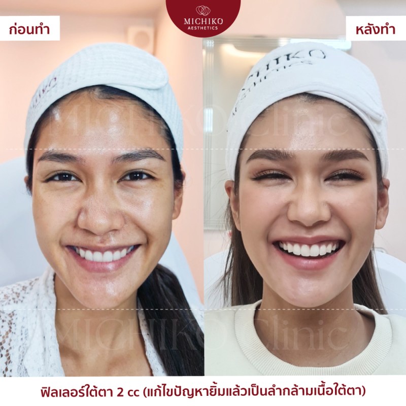 ภาพก่อนและหลังเคสฟิลเลอร์ใต้ตาที่ MICHIKO