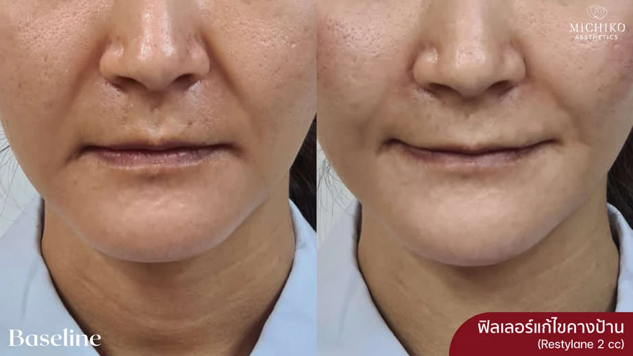 ฉีดฟิลเลอร์แก้คางป้าน Restylane 2 cc