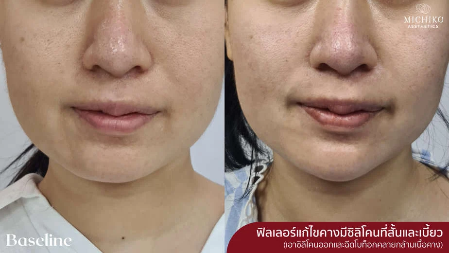 ฉีดฟิลเลอร์แก้ไขคางมีซิลิโคน