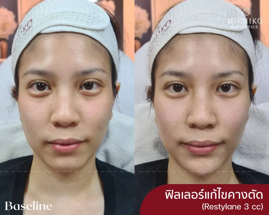 ฉีดฟิลเลอร์แก้คางตัด