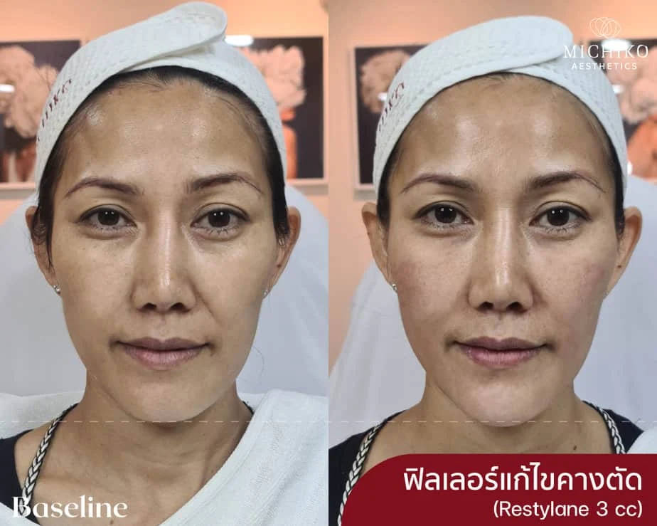 ฟิลเลอร์แก้ไขคางตัด
