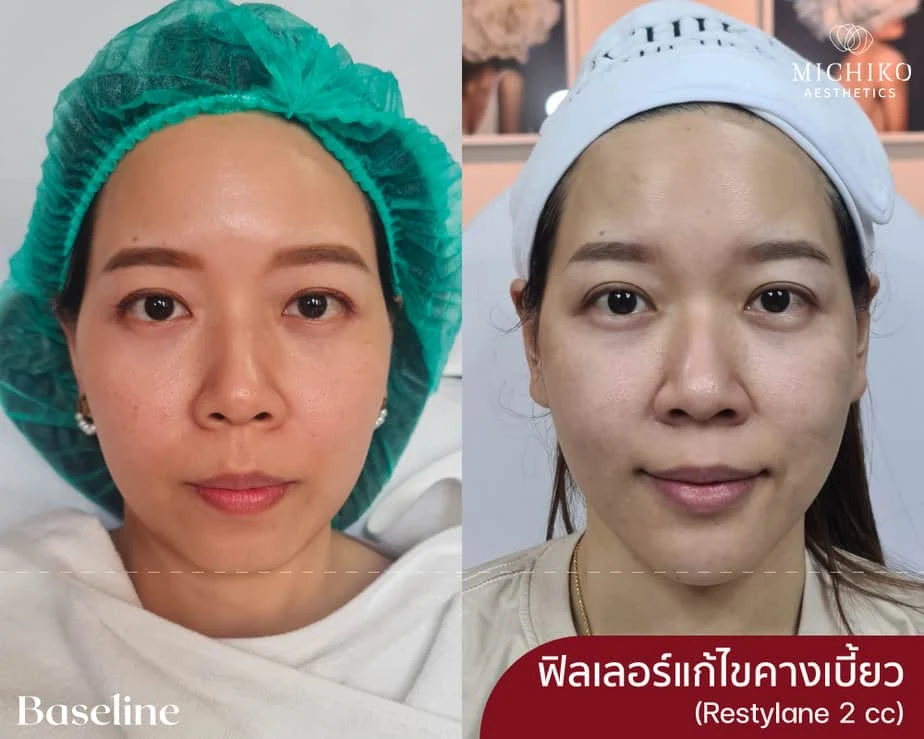 ฉีดฟิลเลอร์คางเบี้ยว Restylane 2 cc