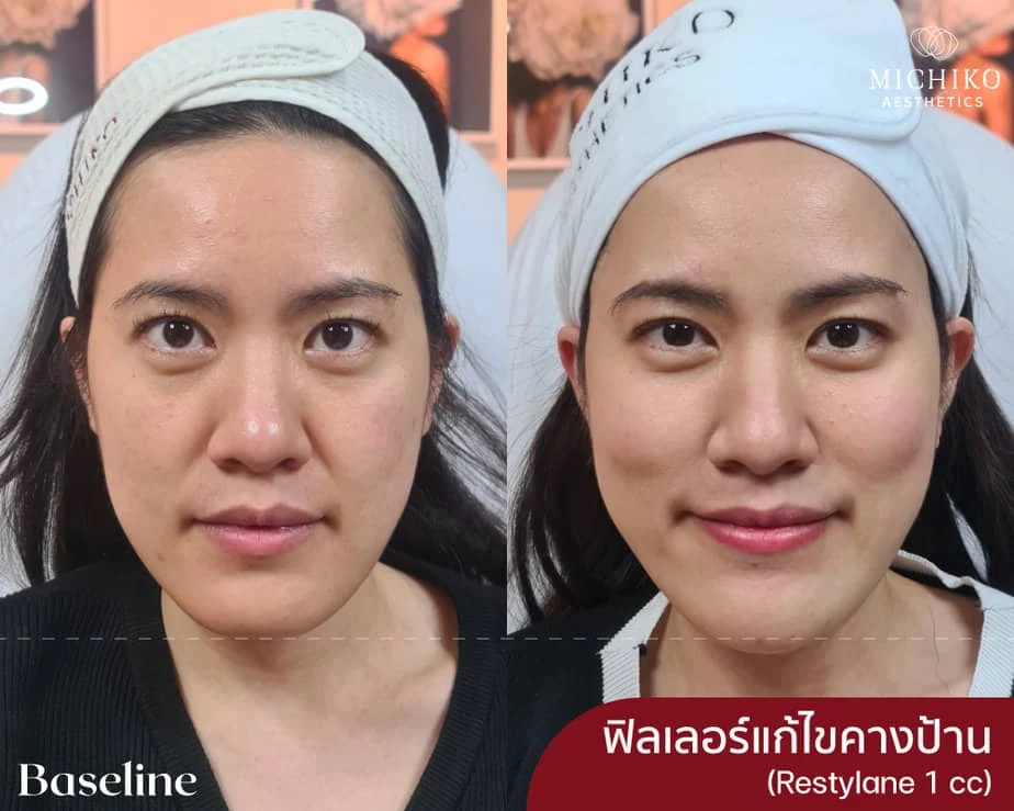 ฟิลเลอร์คาง